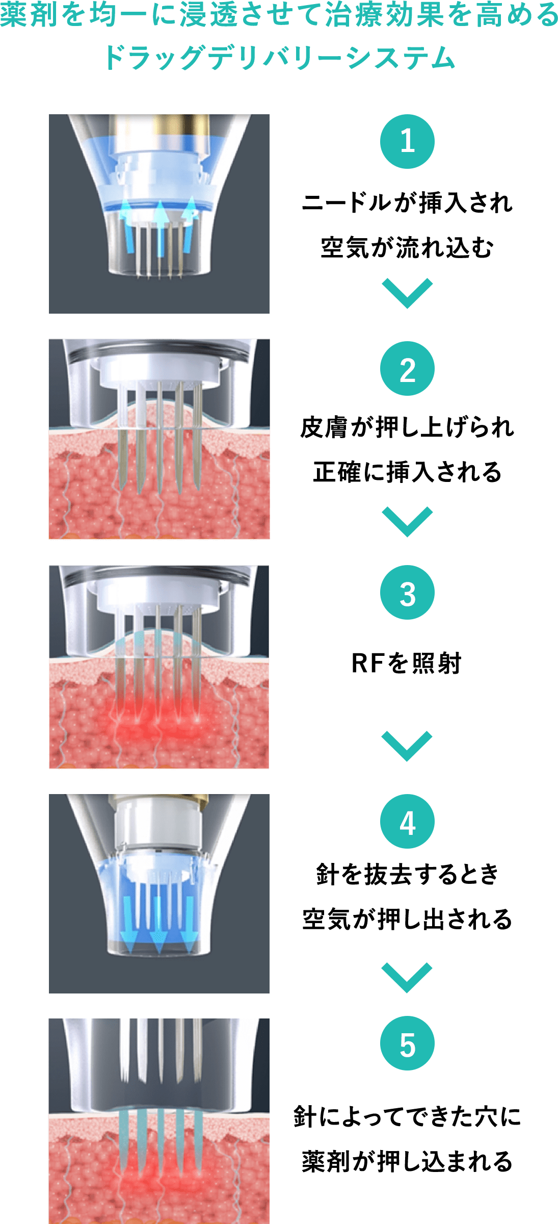 ポテンツァ(POTENZA)| 美容整形クリニックA CLINIC【公式】