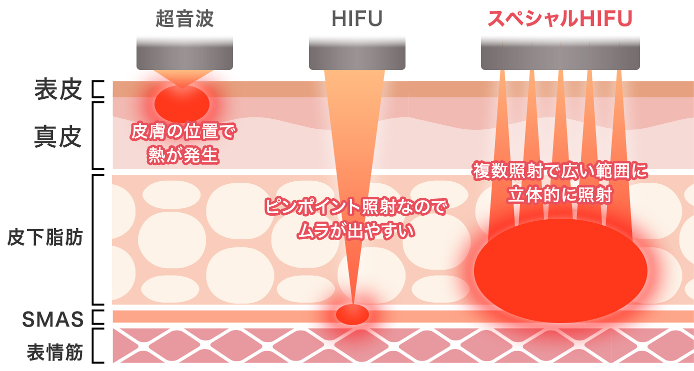 スペシャルHIFUとは