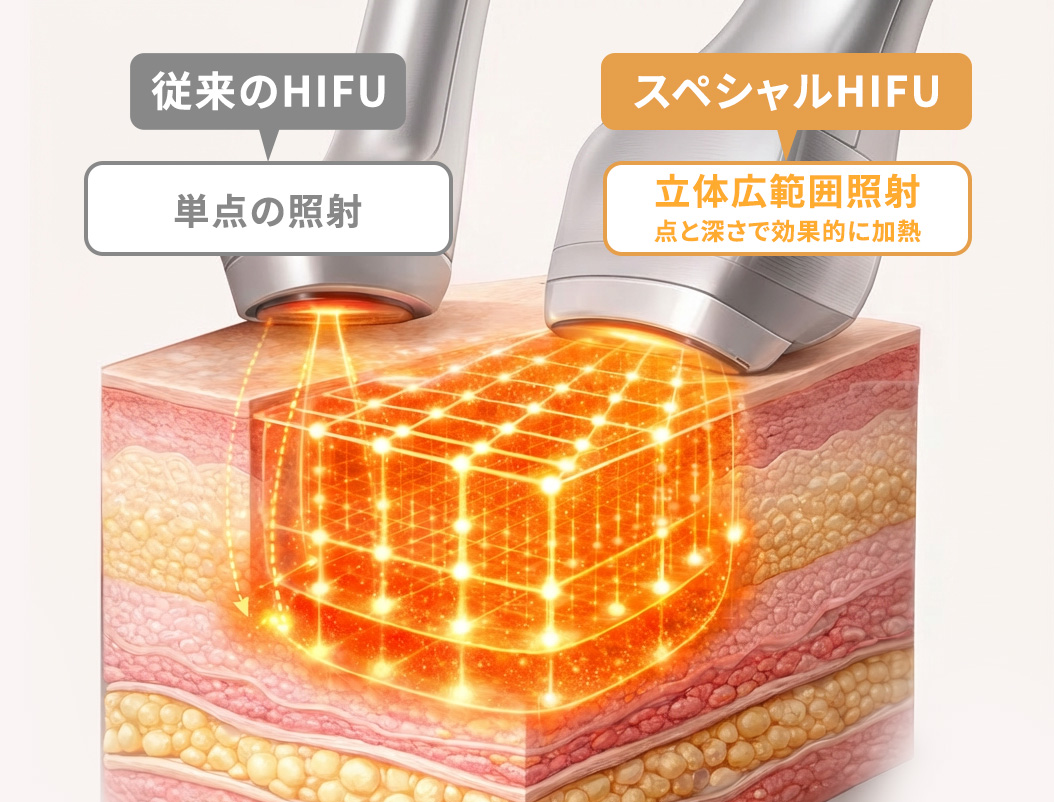 スペシャルHIFUとは