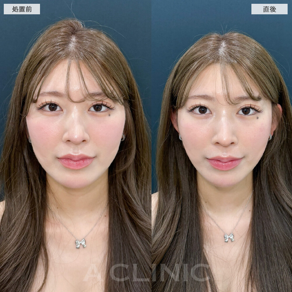 Aスレッド®︎の症例写真