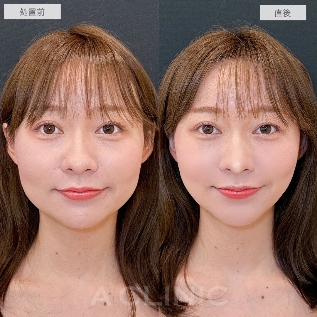 Aスレッド®︎の症例写真