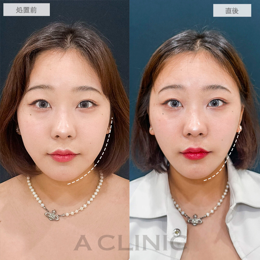 Aスレッド®︎の症例写真
