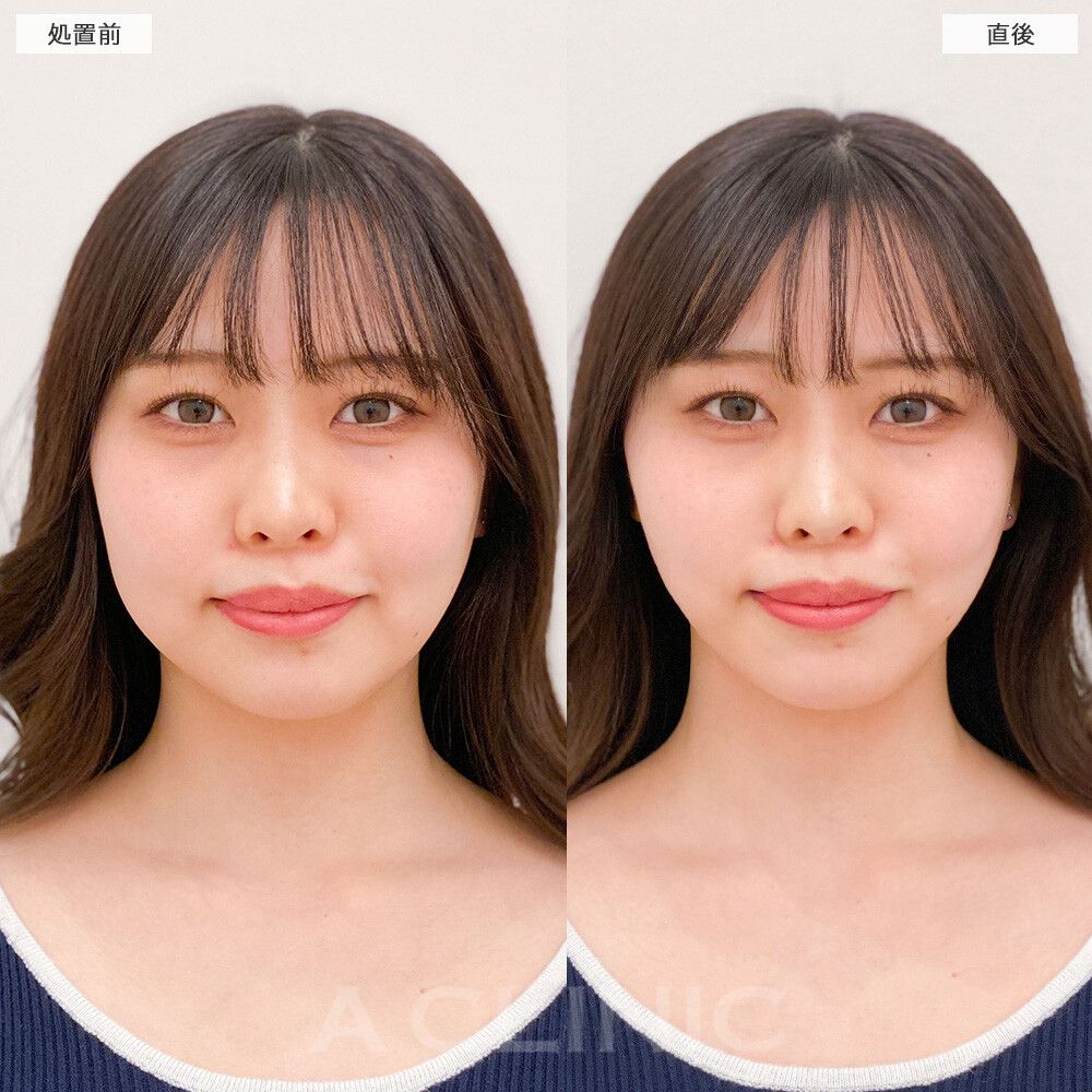 Aスレッド®︎の症例写真