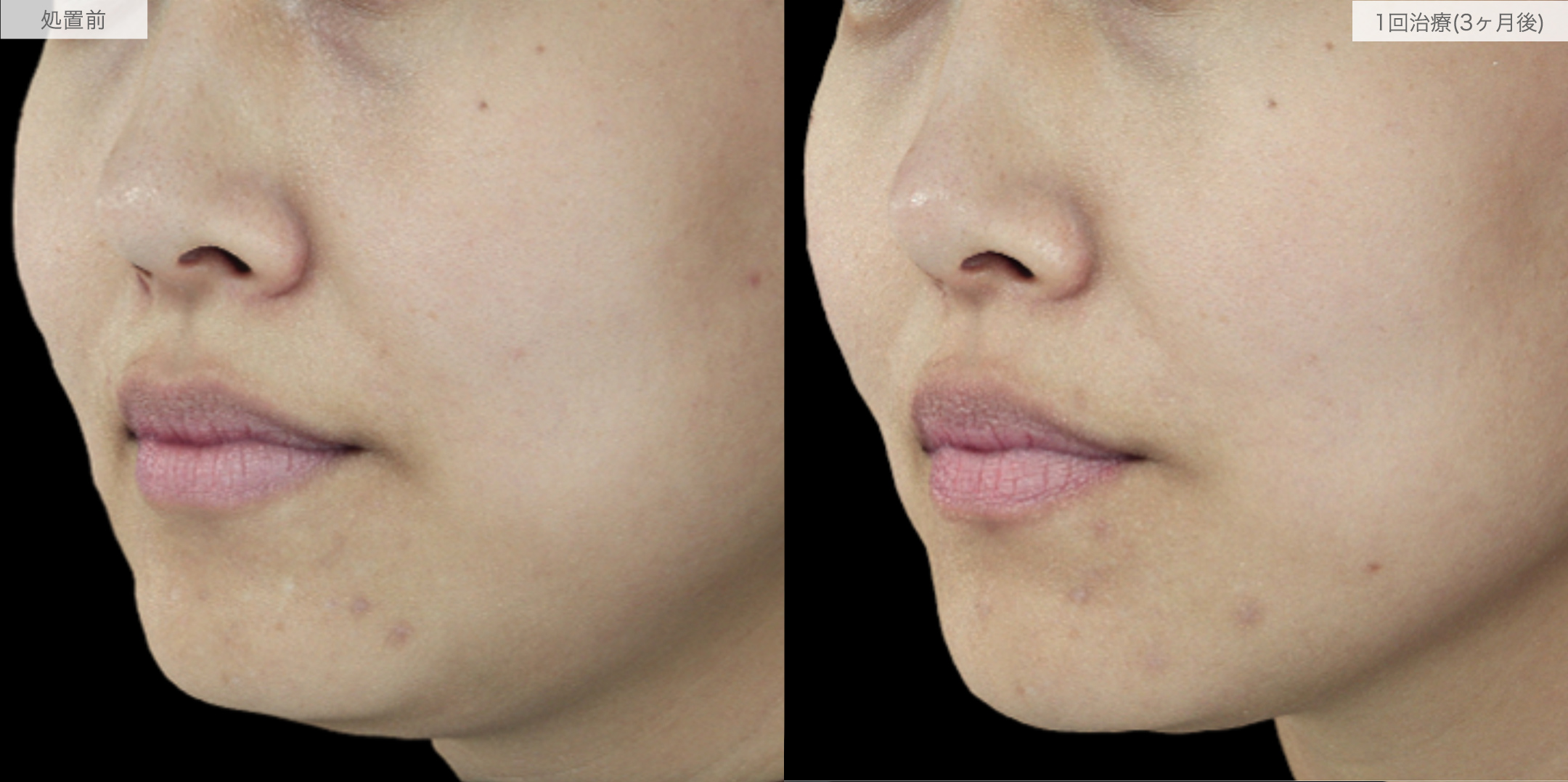 A式ナゾラリフトの症例写真