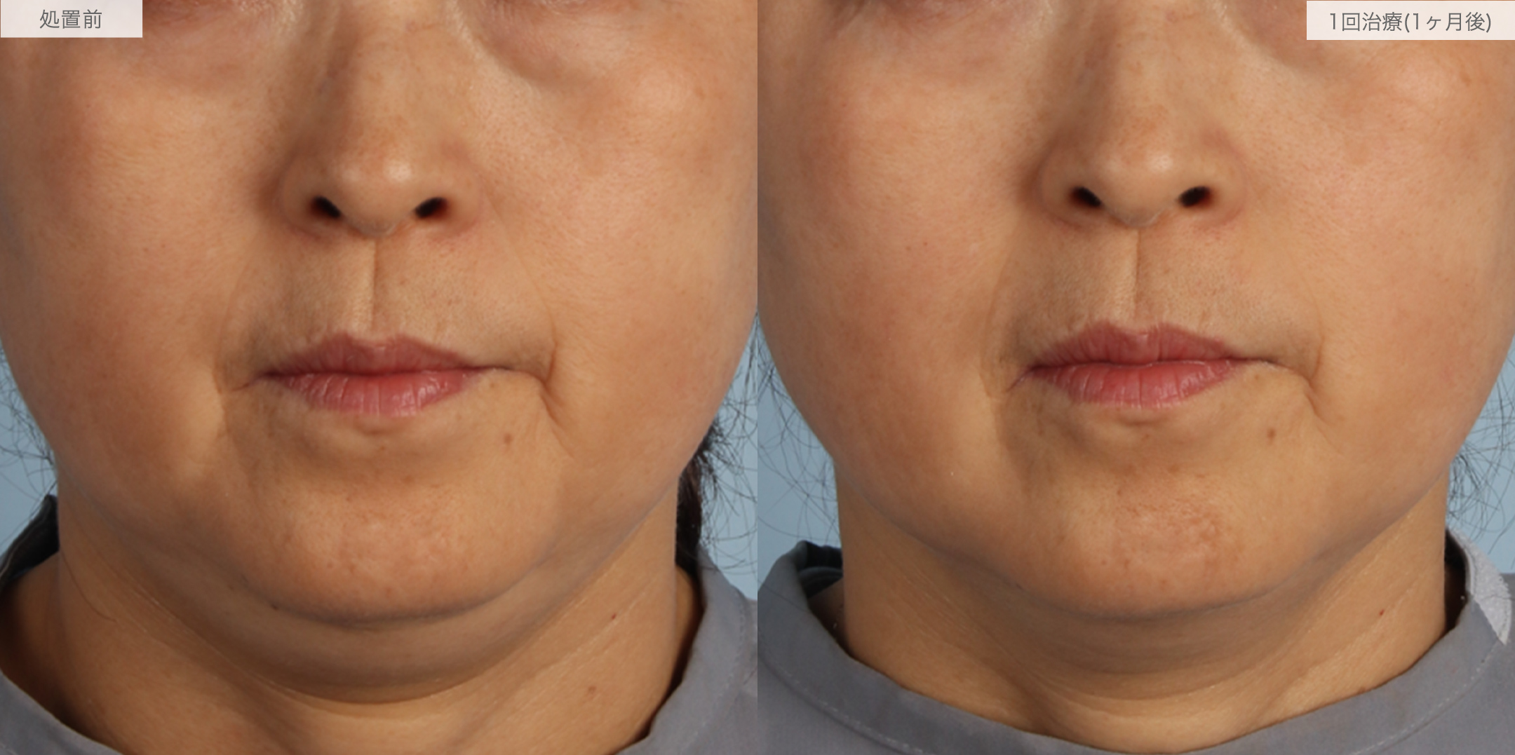 A式ナゾラリフトの症例写真