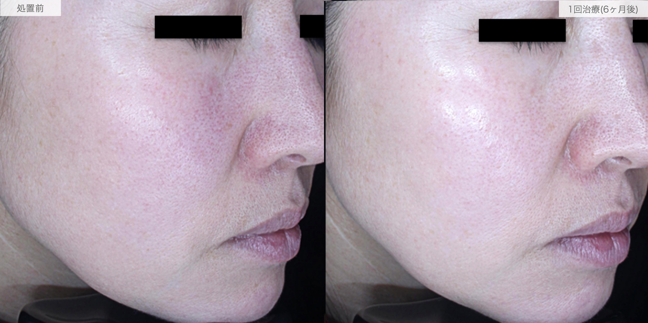 A式ナゾラリフトの症例写真