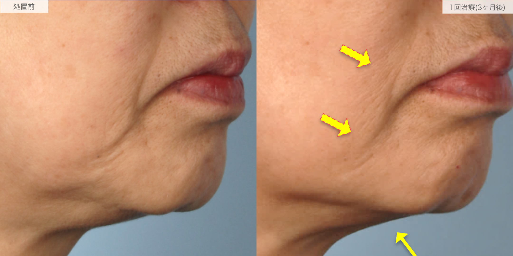 A式ナゾラリフトの症例写真