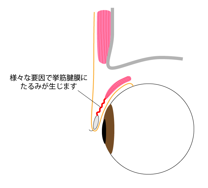 眼瞼下垂症 解剖図