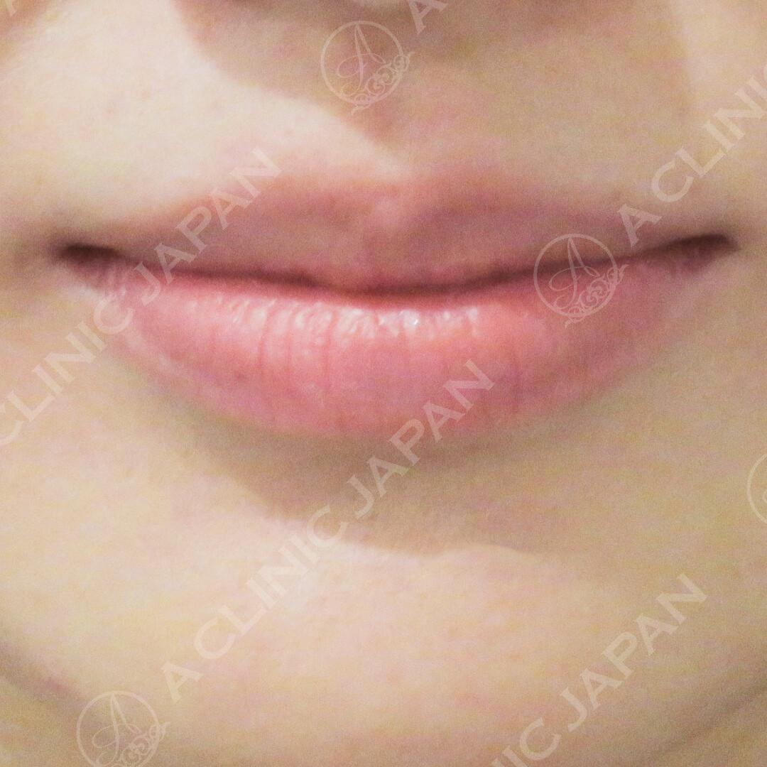 たった10分でぷるぷるな唇に 唇を厚くする ヒアルロン酸 の処置前と上唇 下唇処置後の症例です 代女性 A Clinicは小顔 リフトアップ専門の美容整形クリニック
