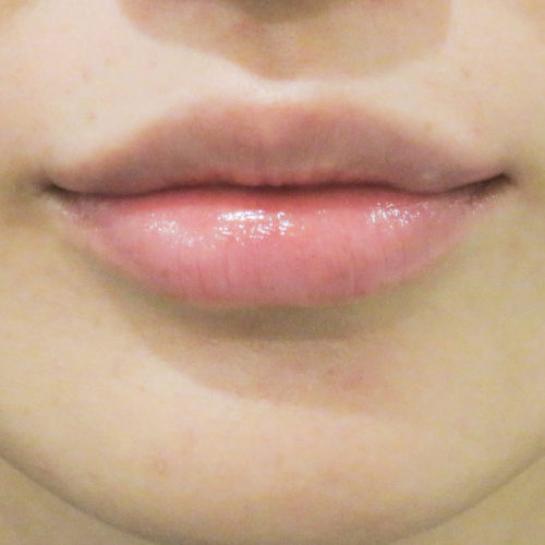 たった10分でぷるぷるな唇に 唇を厚くする ヒアルロン酸 の処置前と上唇 下唇処置後の症例です 代女性 美容整形のa Clinic 美容外科 美容皮膚科 形成外科