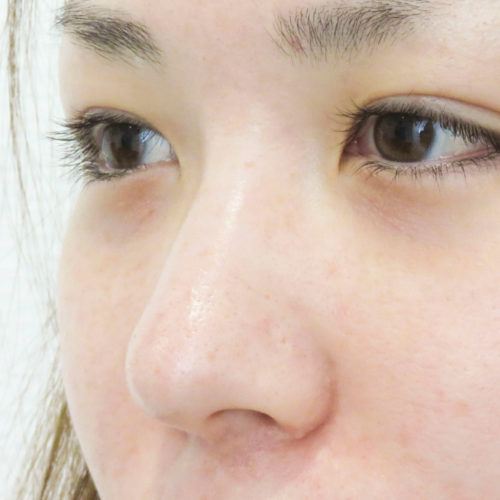 鼻根を高く 鼻筋を通す 簡単ヒアルロン酸注入の隆鼻術の処置前後の症例です 30代女性 A Clinicは小顔 リフトアップ専門の美容整形クリニック