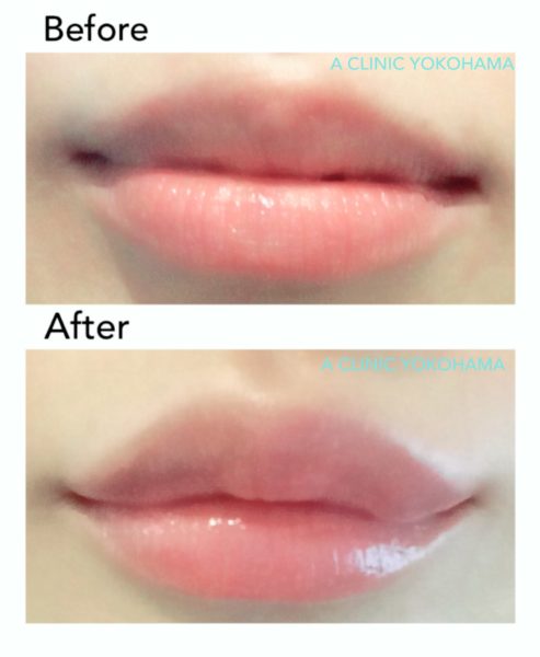 唇を厚くする（リップヒアルロン酸注入） | 美容整形のエークリニック横浜 A CLINIC