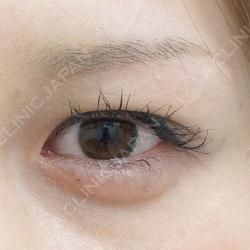 眉下リフトでまるでアイドルのような目元に 眉下リフト 眉下切開法 の処置前と処置後3週間の症例です 代女性 美容整形のa Clinic 美容外科 美容皮膚科 形成外科