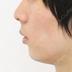 あごをほんの少し出すだけでもお顔の印象はかなり変わります あごのヒアルロン酸注入の処置前と処置直後の症例です 代男性 A Clinicは小顔 リフトアップ専門の美容整形クリニック