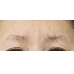 眉間のしわも1ヶ月後にはこの通り 眉間へのボトックス注入 処置前と処置後１ヶ月の症例です 50代女性 美容整形のa Clinic 美容外科 美容皮膚科 形成外科