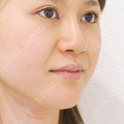 ほうれい線のしわも5分で解消 ほうれい線へのヒアルロン酸注入 処置前と処置直後の症例です 代女性 美容整形のa Clinic 美容外科 美容皮膚科 形成外科