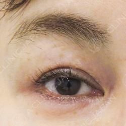 切らない眼瞼下垂術