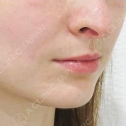 ヒアルロン酸注入でほうれい線のしわ解消 ほうれい線へのヒアルロン酸注入 処置前と処置直後の症例です 30代女性 美容整形のa Clinic 美容外科 美容皮膚科 形成外科