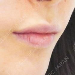 ヒアルロン酸でふっくら唇に 唇へのヒアルロン酸注入の症例です 40代 A Clinicは小顔 リフトアップ専門の美容整形クリニック