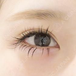 自然なたれ目が可愛い たれ目形成術クイック法の症例です 代女性 A Clinicは小顔 リフトアップ専門の美容整形クリニック