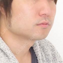 エラ張りさんも小顔になれる エラへのボトックス注入の症例です 30代男性 A Clinicは小顔 リフトアップ専門の美容整形クリニック