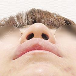 団子鼻を治す鼻先縮小術埋没法 美容整形のa Clinic 美容外科 美容皮膚科 形成外科