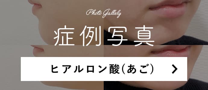 アゴへのヒアルロン酸のポイント