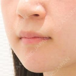 唇をふっくらさせる 唇へのヒアルロン酸注入症例です 代女性 A Clinicは小顔 リフトアップ専門の美容整形クリニック 唇をふっくらさせる 唇へのヒアルロン酸注入症例です 代女性 A Clinicは小顔 リフトアップ専門の美容整形クリニック