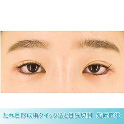 目尻切開法