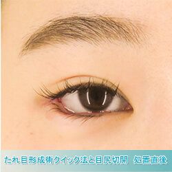 目尻切開法