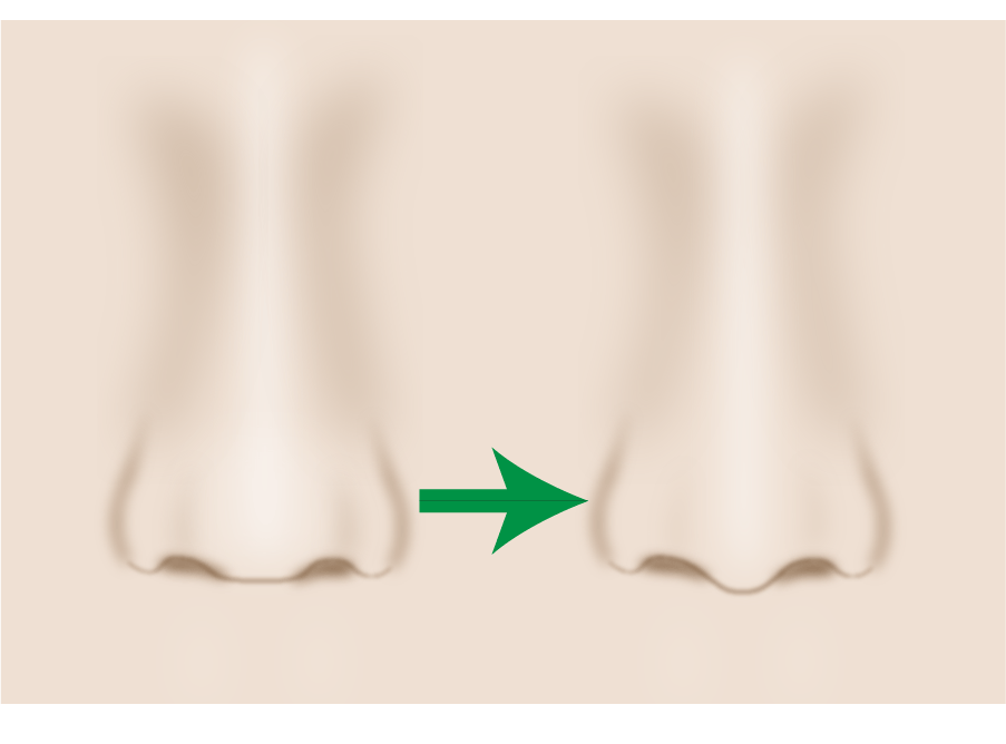 鼻先を下へ向けるヒアルロン酸注入 美容整形のa Clinic 美容外科 美容皮膚科 形成外科