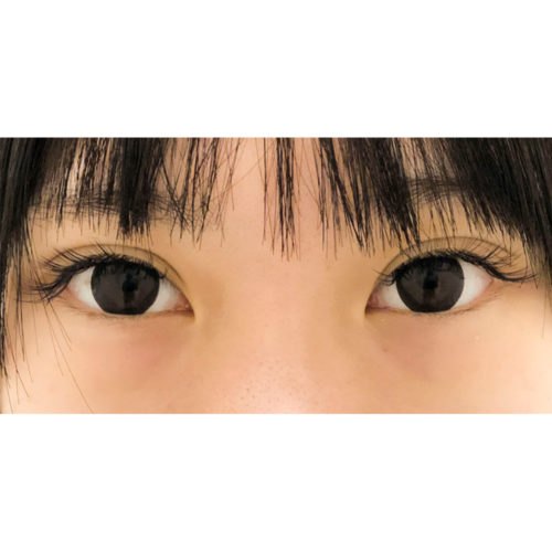 切らずに可愛いたれ目になれる たれ目形成術クイック法の症例です 代女性 A Clinicは小顔 リフトアップ専門の美容整形クリニック