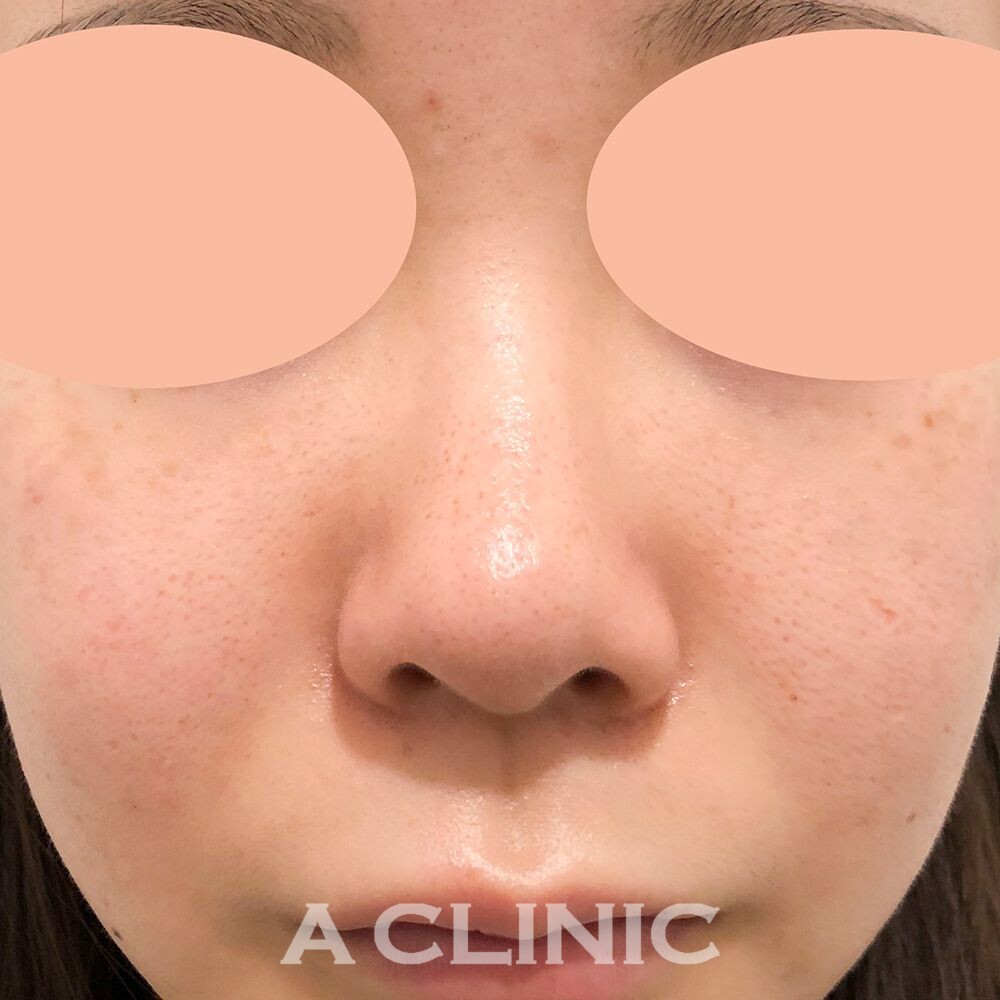 【A CLINIC 横浜 院長柴田貴志】ヒアルロン酸クレヴィエルでお鼻を高くする！ジャスミンノーズの症例写真です(20代女性) BEFORE