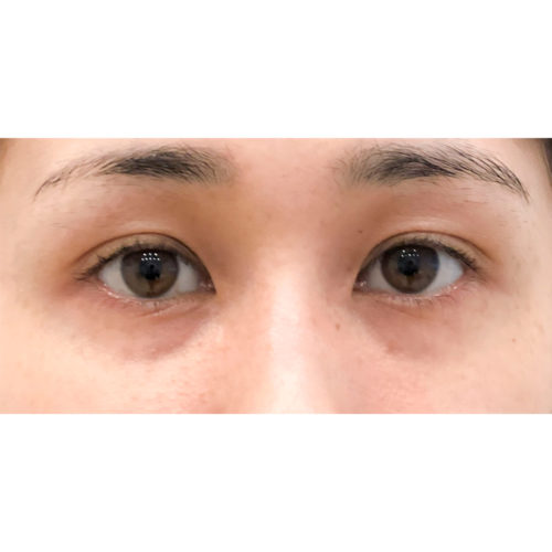 目の下のクマや小じわでお悩みの方に 目の下へのサーモン注射 Pdrn の症例です 30代女性 美容整形のa Clinic 美容外科 美容皮膚科 形成外科