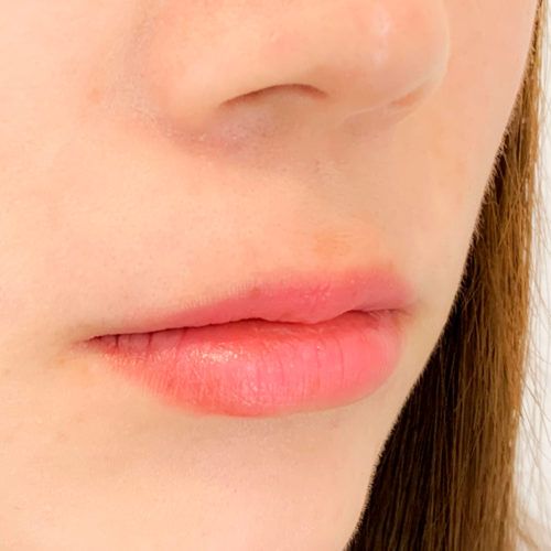 A Clinic 横浜 銀座 医師小松塁 アヒル口やm字型リップも自由自在 唇へのヒアルロン酸注入の症例写真です 30代女性 A Clinicは小顔 リフトアップ専門の美容整形クリニック