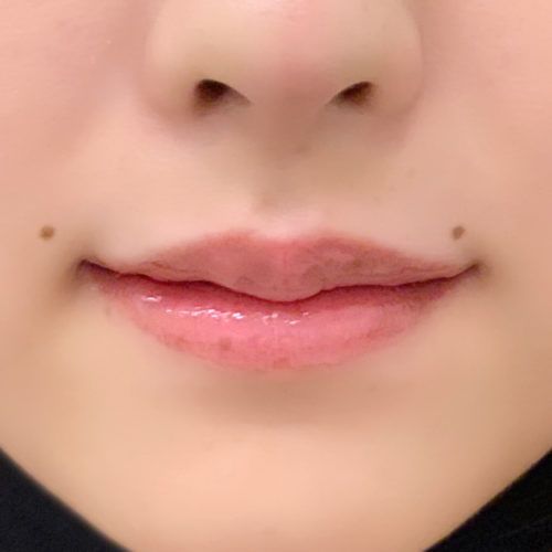 唇の形を整えイメージチェンジ 施術直後のお写真です 代女性 A Clinicは小顔 リフトアップ専門の美容整形クリニック