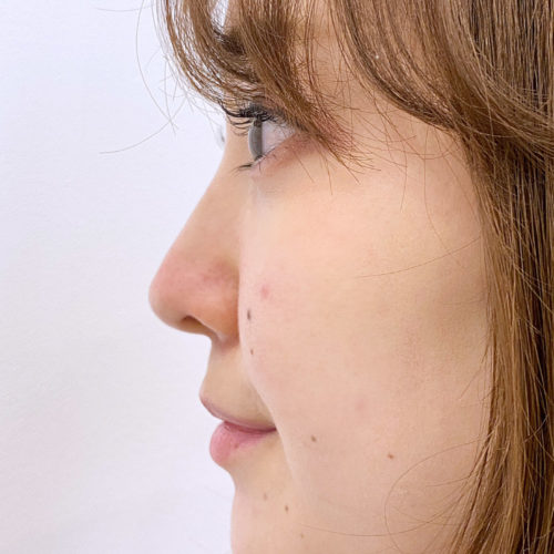 横顔が変わる A式鼻先シャープ術で理想の鼻を形成する 代女性 美容整形のa Clinic 美容外科 美容皮膚科 形成外科