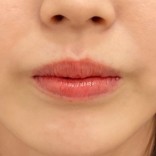 口角挙上術でキュッと上がった口角を半永久的に手に入れませんか 代女性 A Clinicは小顔 リフトアップ専門の美容整形クリニック