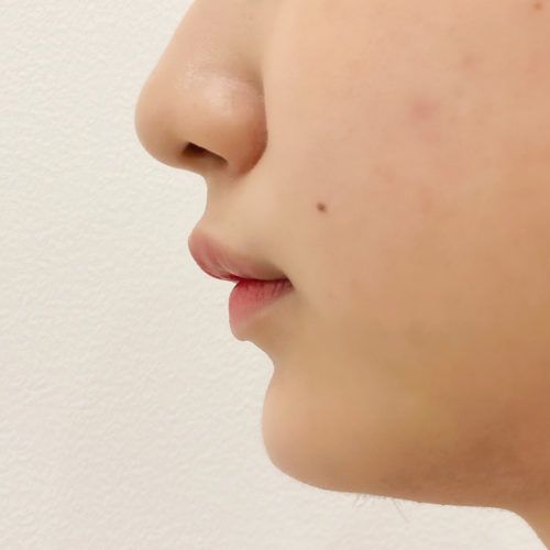 ダウンタイムはほぼ無し 顎へのヒアルロン酸注入で直後から横顔美人に 美容整形のa Clinic 美容外科 美容皮膚科 形成外科