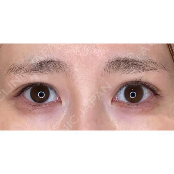 抜糸不要 通院不要の目尻切開 たれ目形成術クイック法と目尻切開の症例です 30代女性 美容整形のa Clinic 美容外科 美容皮膚科 形成外科