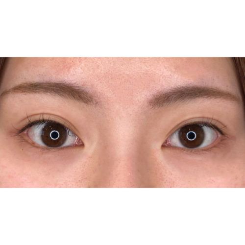 二重幅の左右差解消で さらにパッチリした目元へ 処置前と術後2週間後の症例です 代女性 美容整形のa Clinic 美容外科 美容皮膚科 形成外科