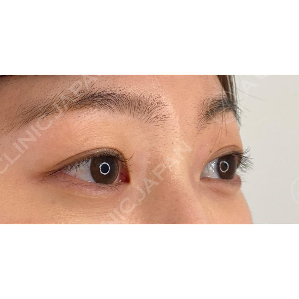 右目のみ施術で左右差改善 二重術埋没法と目の上の脂肪取り処置前と1週間後の症例です 代女性 A Clinicは小顔 リフトアップ専門の美容整形クリニック