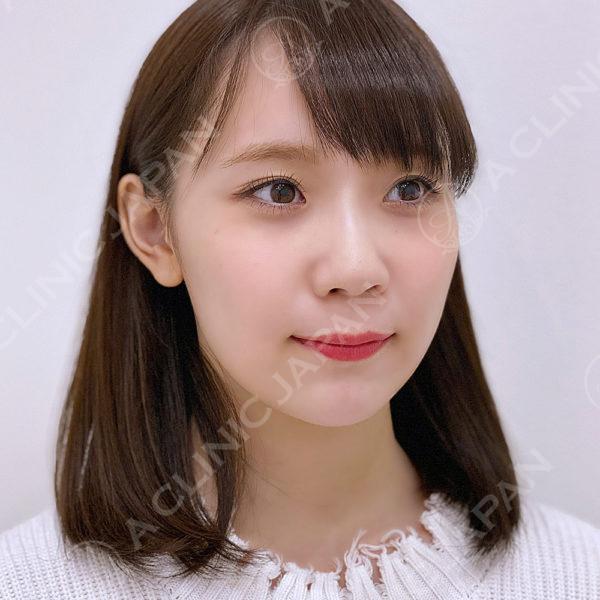 Aスレッド だけで面長型から卵型へ 小顔術の処置前と処置直後の症例です 代女性 A Clinicは小顔 リフトアップ専門の美容整形クリニック