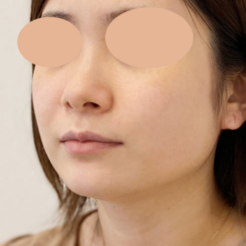 注入のみで簡単小顔に エラへのボトックス注射の1ヶ月後の症例です 30代女性 A Clinicは小顔 リフトアップ専門の美容整形クリニック