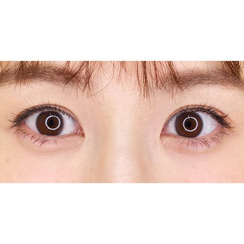 涙袋へのヒアルロン酸注入で大きく優しいお目元に 処置直後の症例です 30代女性 美容整形のa Clinic 美容外科 美容皮膚科 形成外科