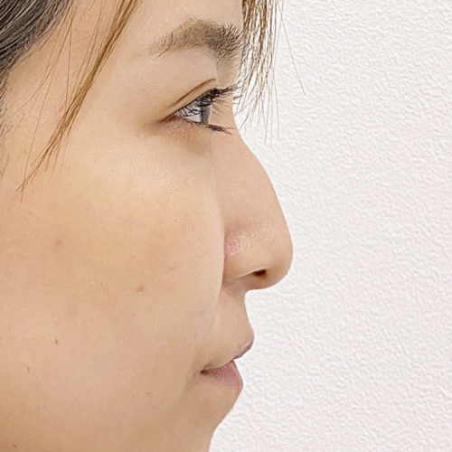鷲鼻改善もa式鼻先シャープ術で 処置後2週間の症例です 代女性 A Clinicは小顔 リフトアップ専門の美容整形クリニック