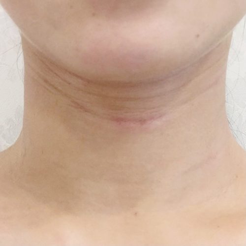 首のシワ気になりませんか 意外と見られる首のシワはぷる美注射で解決 代女性 美容整形のa Clinic 美容外科 美容皮膚科 形成外科