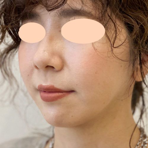 ダイエットでも落ちないお顔のお肉は脂肪吸引で無くしませんか 3週間後にはスッキリ小顔に 30代女性 美容整形のa Clinic 美容外科 美容皮膚科 形成外科
