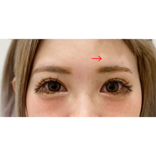 左右差のある目元をボトックス注射で改善 処置後1ヶ月の症例です 30代女性 美容整形のa Clinic 美容外科 美容皮膚科 形成外科