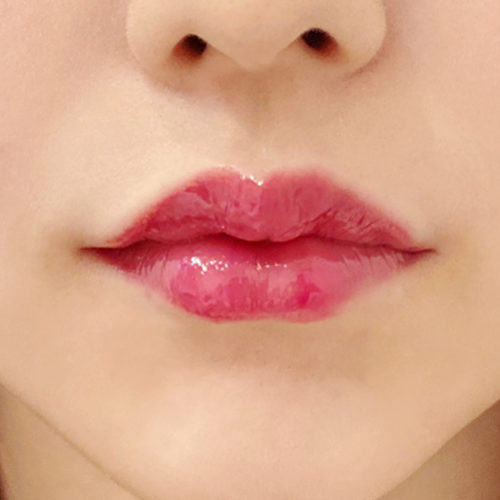左右差を整えぷっくり可愛い唇にデザイン スマイルリップの処置直後の症例写真です 代女性 A Clinicは小顔 リフトアップ専門の美容整形クリニック